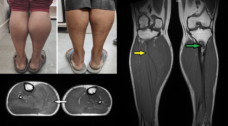   Aditya Chaudhry et al. / BMJ Case Reports, 2025