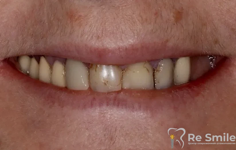 Пациентка обратилась с жалобами на частичное отсутствие зубов, разрушенность и подвижность на обеих челюстях.