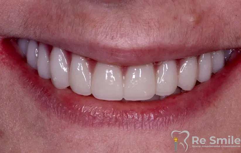 Была проведена полная диагностика, снятие старой ортопедической конструкции, удаление не состоятельных зубов и корней.

Одномоментно установлены импланты по технологии All-on-6 с немедленной нагрузкой.