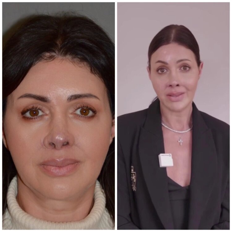 Алиса Аршавина после многочисленных пластических операций на нос📷
