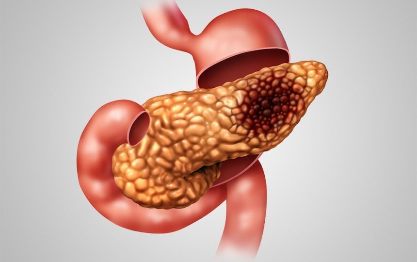 Как распознать и остановить острый и хронический панкреатит — пока не стало слишком поздно
