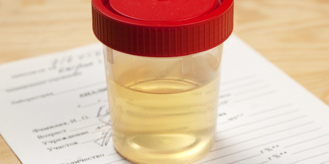 О чем расскажет анализ мочи