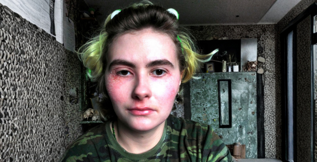 «Во время обострения даже чихать — невероятно больно, а лицо превращается в кровавую маску»