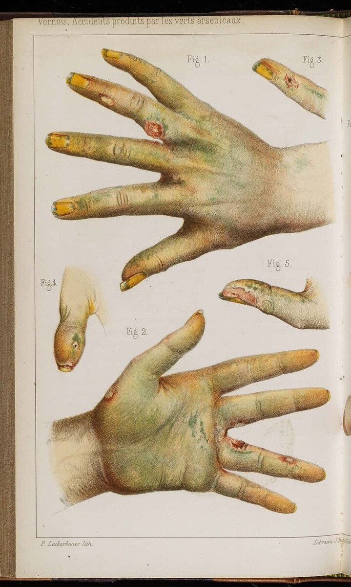 Источник: ranker.com/list/dangerous-historical-fashion-trends/christina-chilin