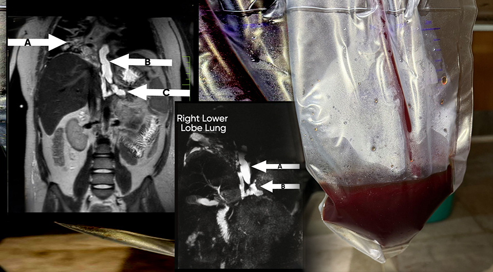   N + 1; Hans Vaish et al. / BMJ Case Reports, 2025