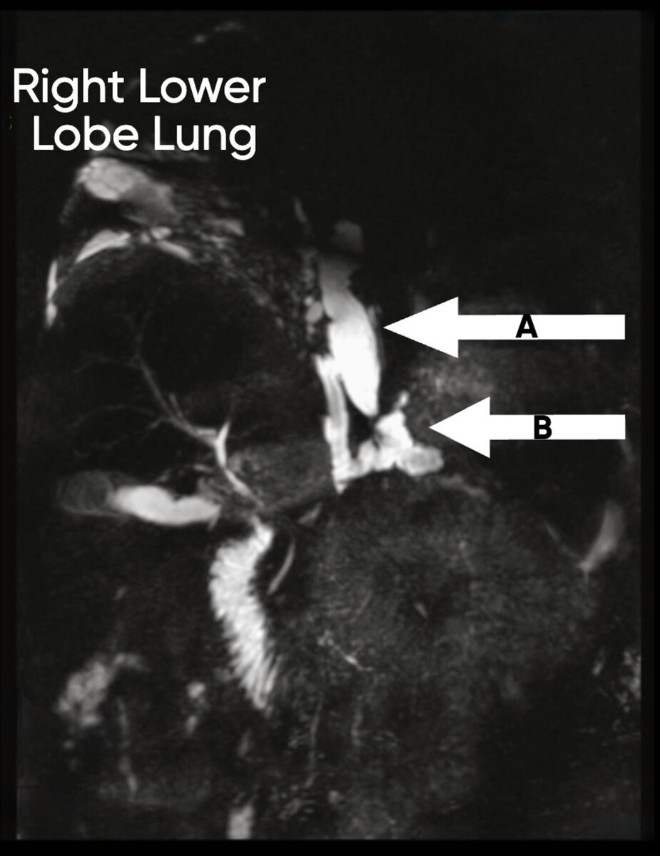   Hans Vaish et al. / BMJ Case Reports, 2025