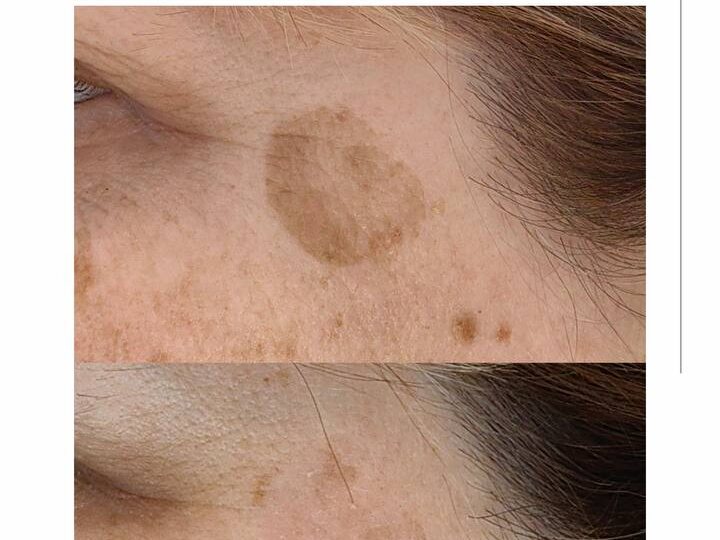 Почему лучше не откладывать удаление пигментных пятен