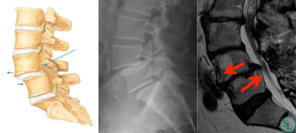 Спондилолистез и ретролистез — когда позвонки «ездят», а вы не понимаете почему.