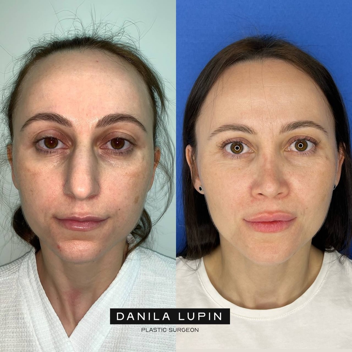 Моя пациентка. Выполнили риносептопластику с восстановлением носового дыхания.