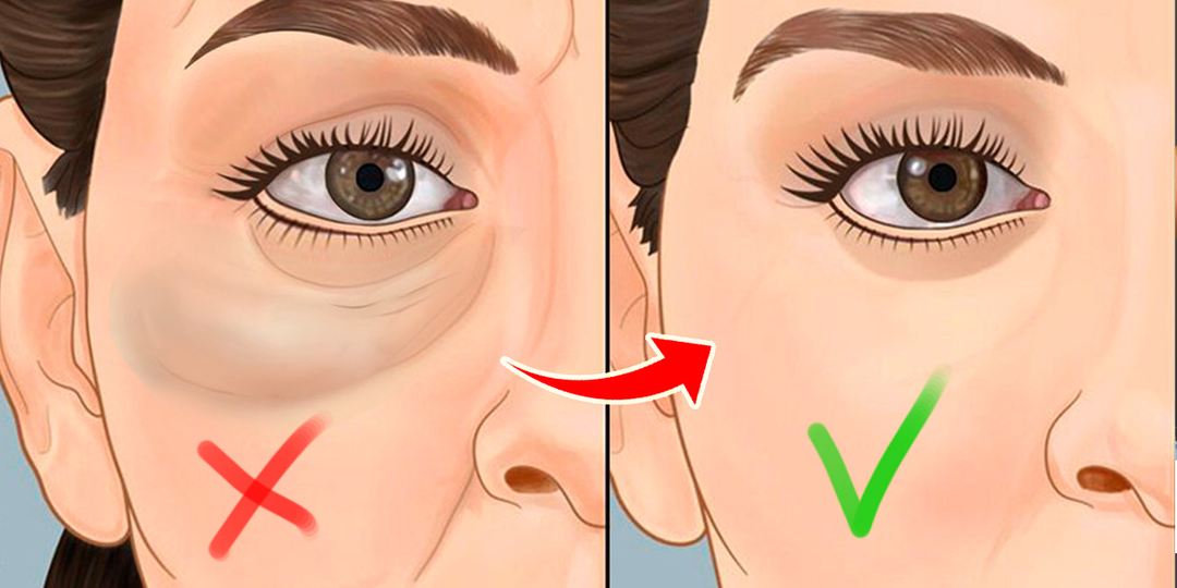 Мешков, тёмных кругов под глазами не будет и даже отеки уйдут: любимый вариант массажа лица