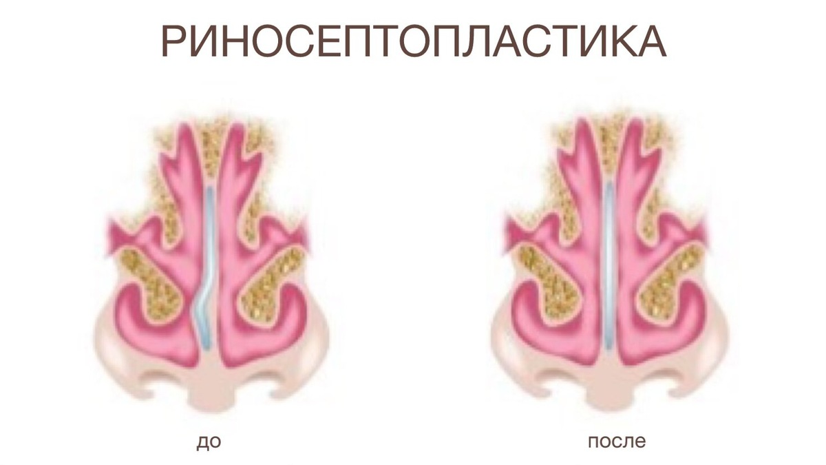 Риносептопластика - коррекция эстетических недостатков, связанных с искривлением носовой перегородки, и устранение затрудненного дыхания
