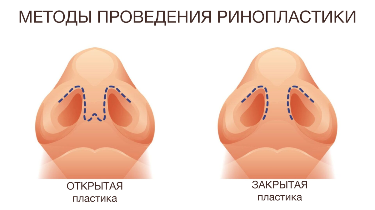 Методы проведения пластики носа. Где находится хирургический доступ