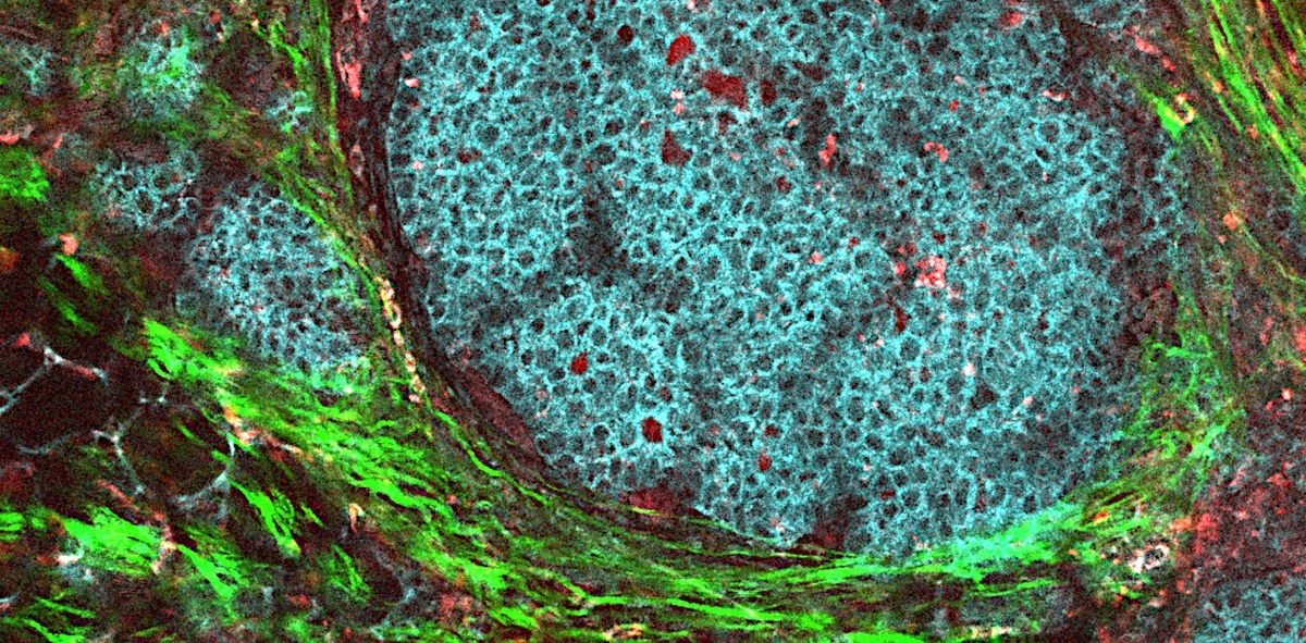 Клетки опухоли молочной железы (голубым цветом) и ее микроокружение у мыши. Красным цветом отмечены иммунные клетки макрофаги, зеленым –коллагеновые волокна. Многофотонная микроскопия и эндогенная флуоресценция. © CC BY-NC 2.0/National Cancer Institute, NIH