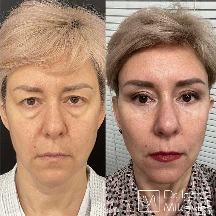 Выполнены: эндоскопическая подтяжка лба и открытый чеклифт (лифтинг средней трети лица). 