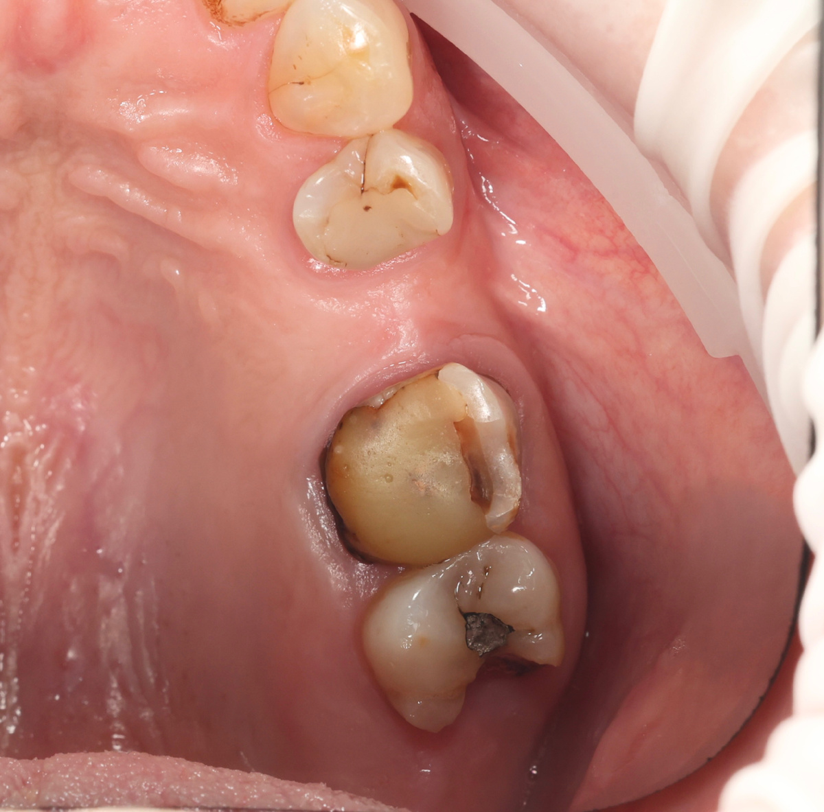 Верхняя челюсть, правая сторона, жевательный сегмент