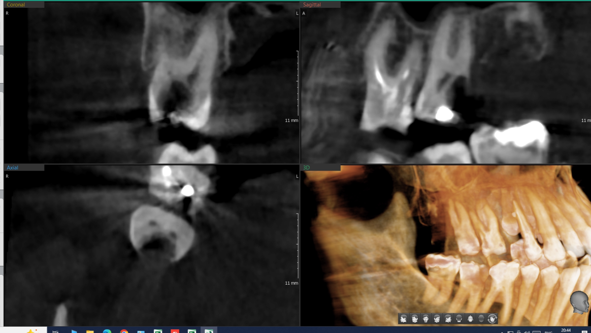 Зуб 1.7 до лечения