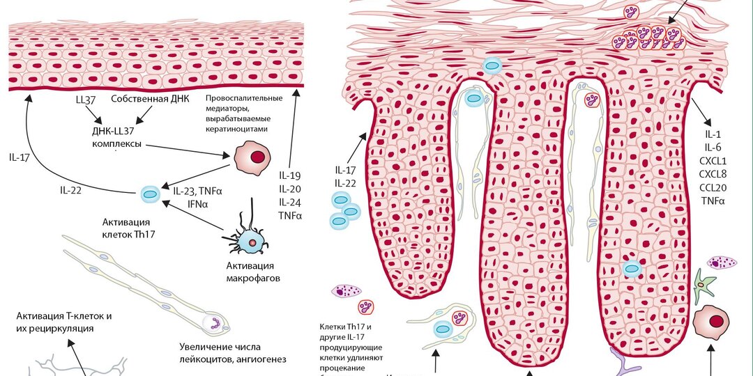 Псориаз на коже: где появляется первым и как меняется со временем