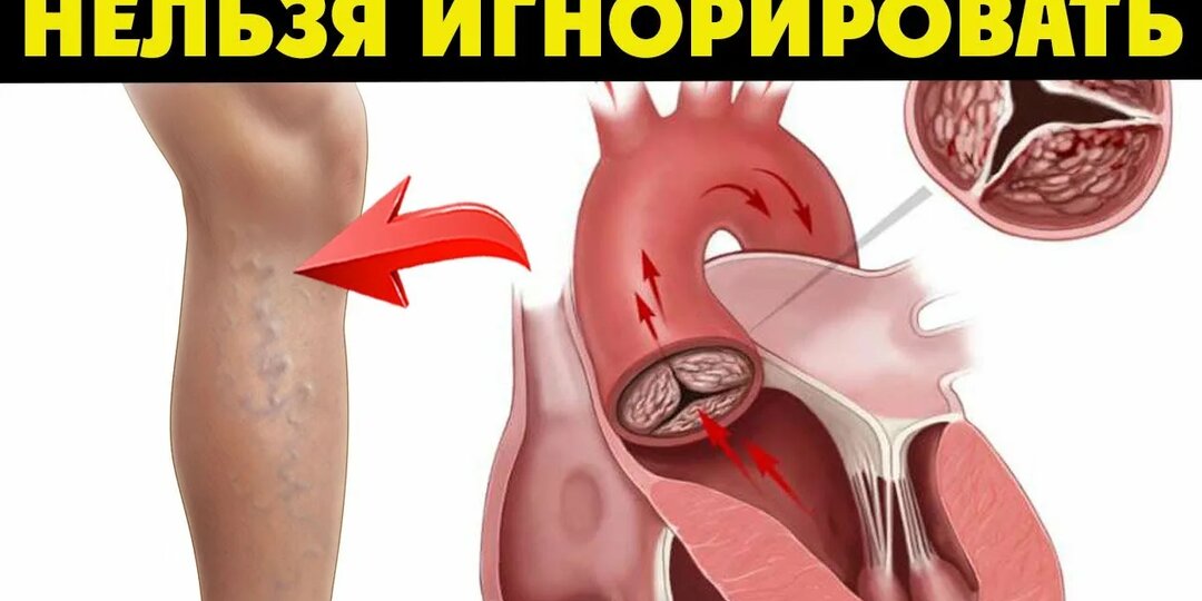 Счёт пойдёт на минуты: Первые признаки отрыва тромба — что делать в первую очередь и кто в зоне риска, рассказывает врач