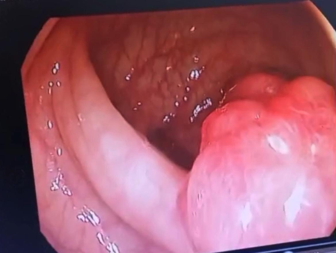 Полип толстой кишки