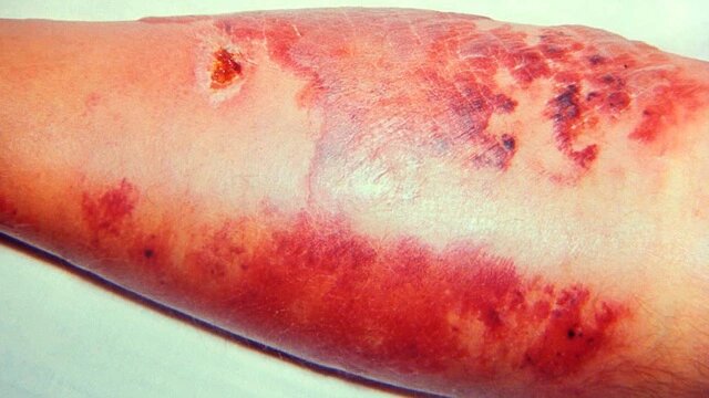 Рожистое воспаление на ноге.