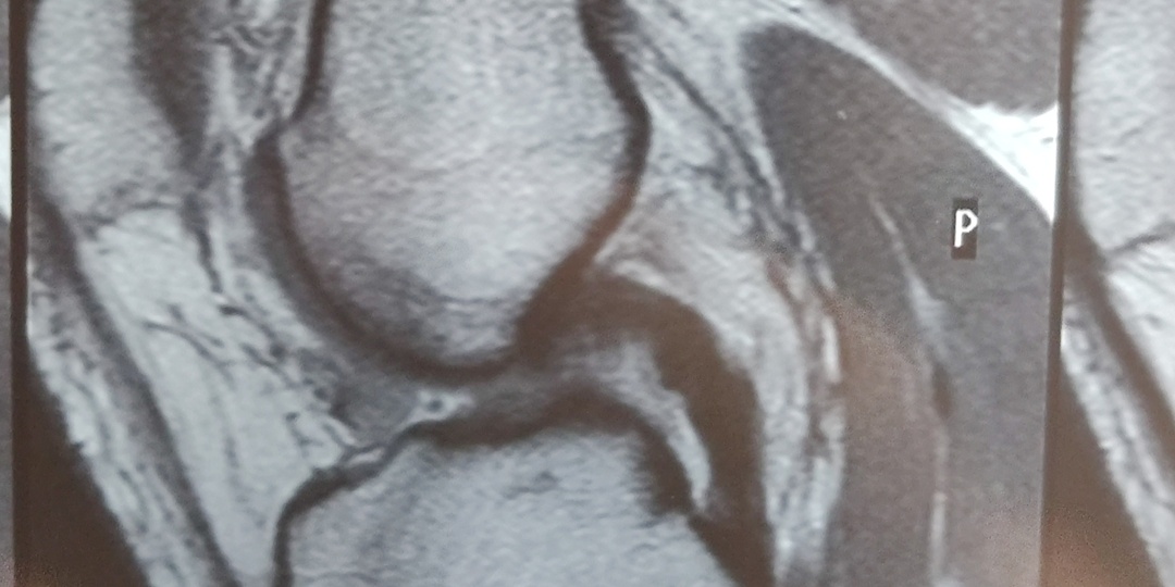 Разрыв передней крестообразной связки коленного сустава. Мой опыт. Часть 1