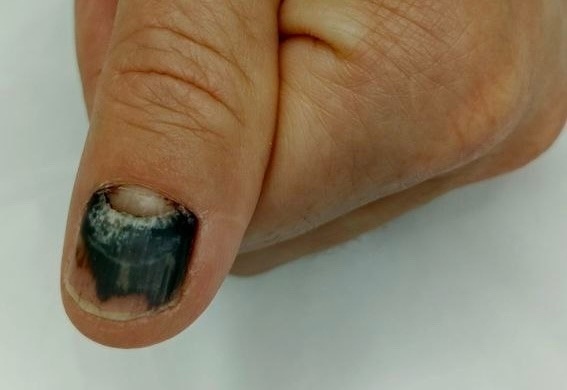 Подногтевая гематома: не просто синяк.