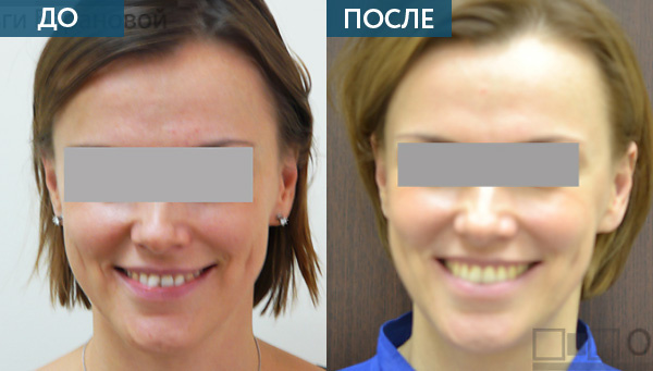 Лечение скученности зубов, фото