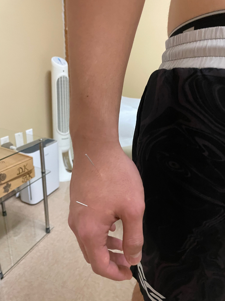 Акупунктура оплачивается медицинской страховкой. Дома делаю сама иглоукалывание и массажи, но и дополнительное лечение не помешает у корейского акупунктуриста