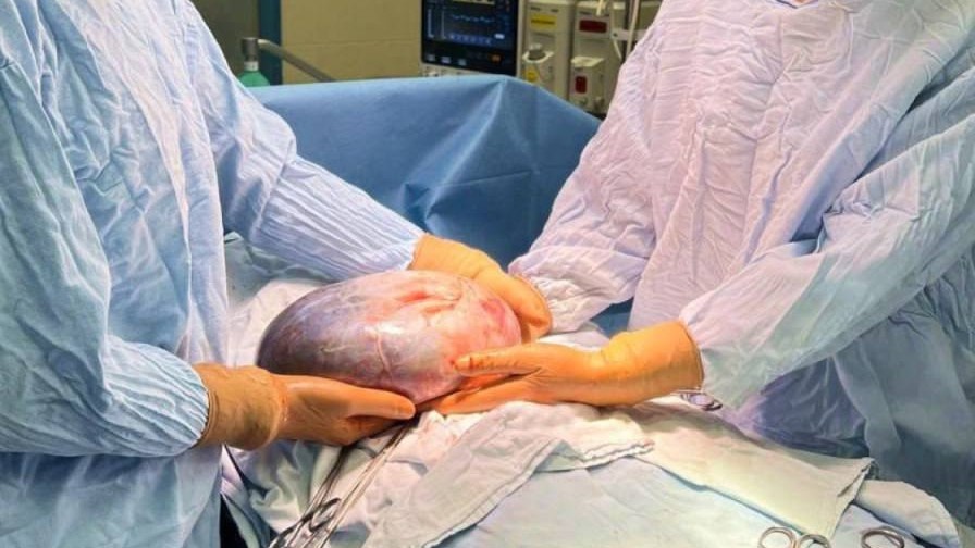    В Сургуте пенсионерке удалили опухоль размером со страусиное яйцо