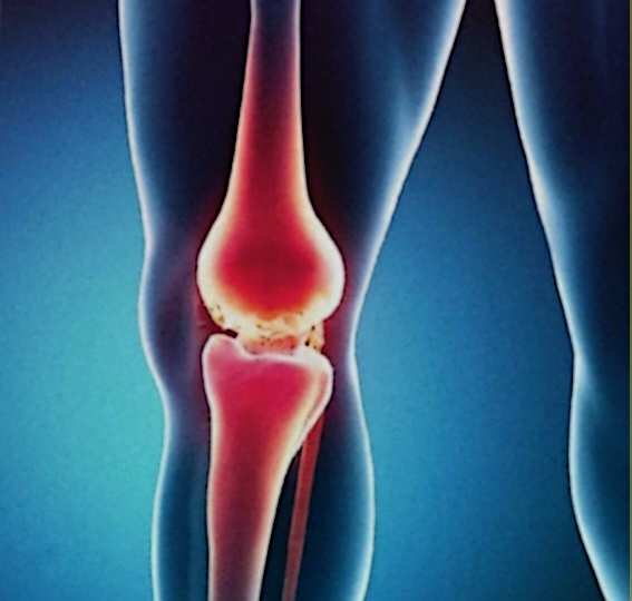 Остеоартрит в молодости: Неожиданные причины и как их понять