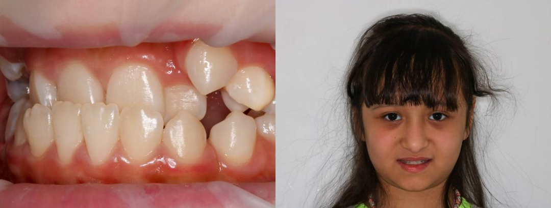 Девочка перестала улыбаться в 11 лет: история одной 11-летней пациентки и то, что за этим скрывалось