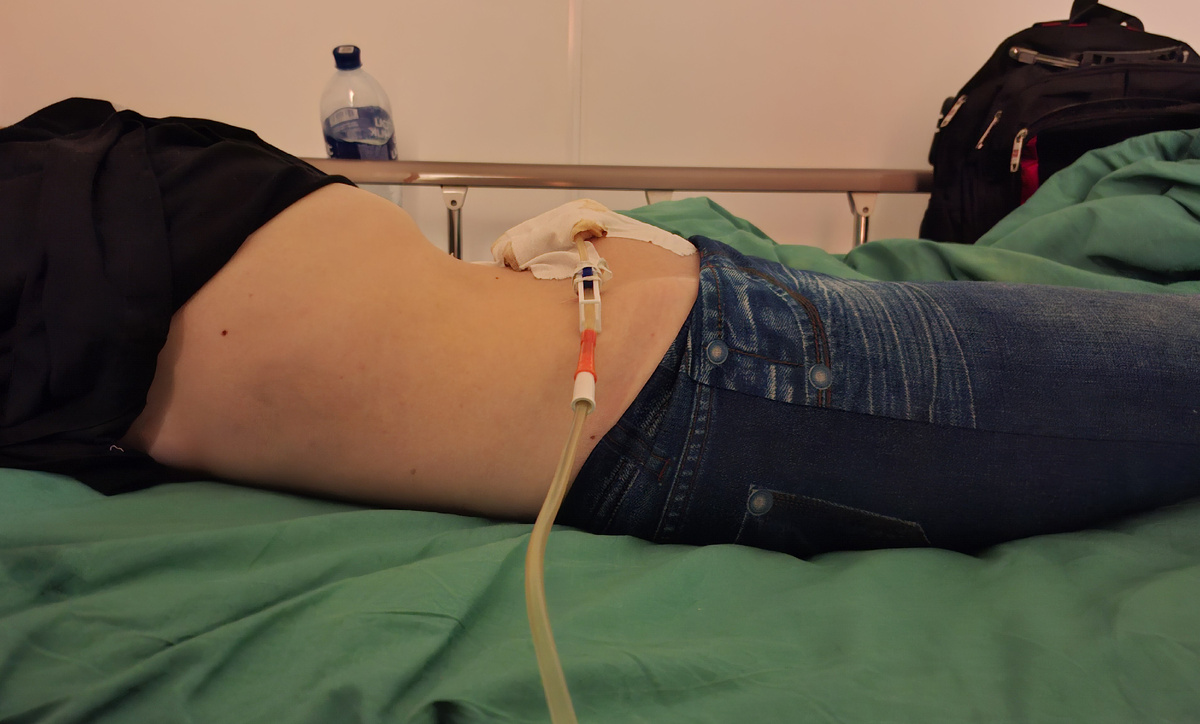 Слили почти весь асцит