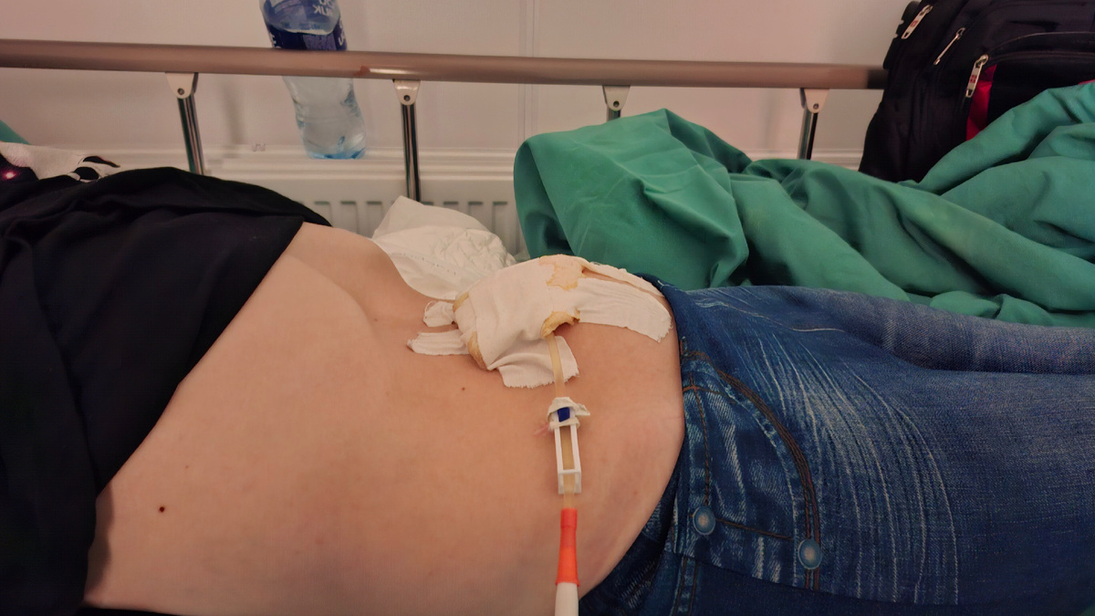 Лапароцентез