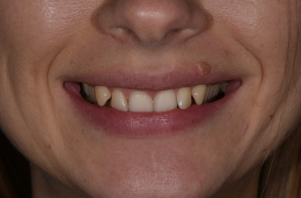 зубы за клыками уходят вовнутрь, сужая улыбку и образуя большое расстояния от губ до зубов - щечный коридор.