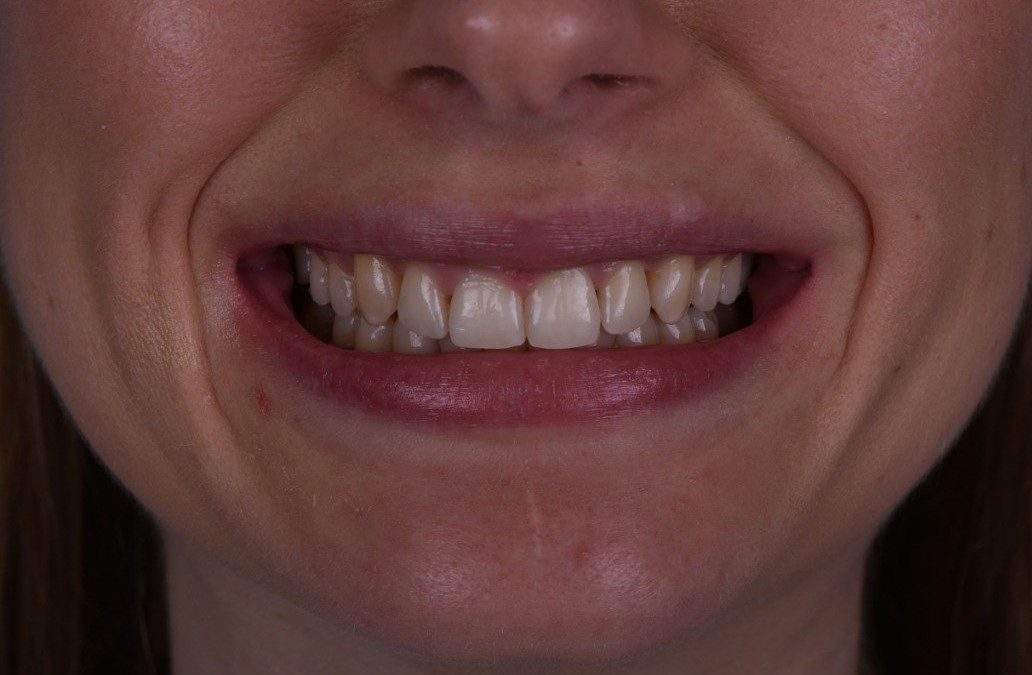 зубы на верхней челюсти больше не наклонены внутрь, расстояние от губ до зубов уменьшилось, и улыбка получается широкой