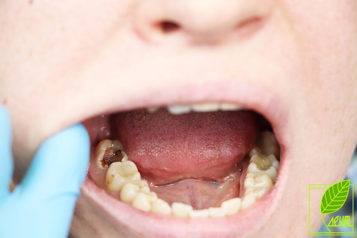 кариес дети почему