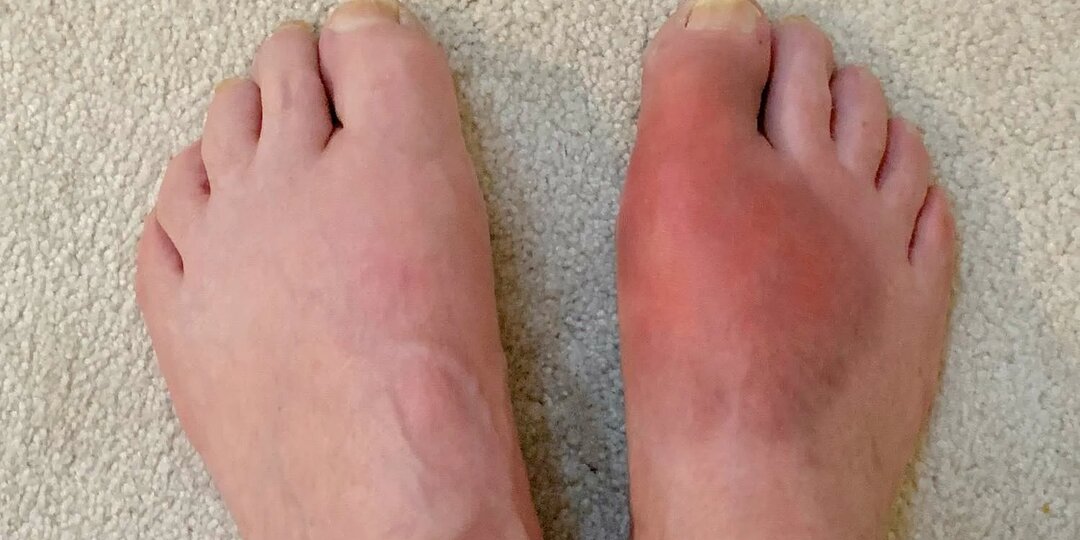 Подагра не приговор: как еда может стать вашим союзником — и что действительно стоит убрать из рациона