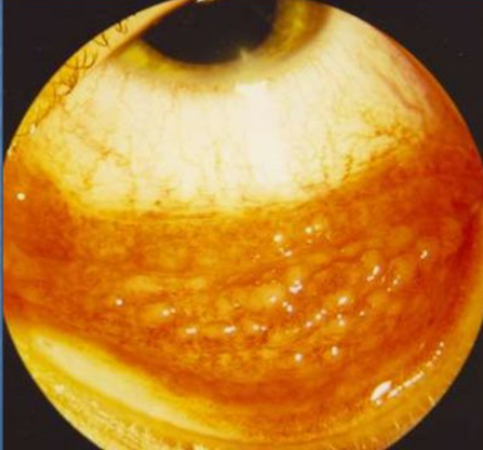 Примерно так выглядят фолликулы на веке в "расцвете" хламидийного конъюнтивита