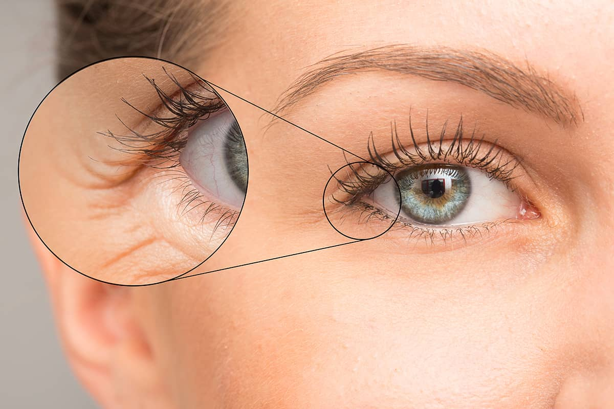 Гусиные лапки могут быть как мимическими складками, так и стойкими морщинами, и именно это различие определяет подход к уходу и коррекции.