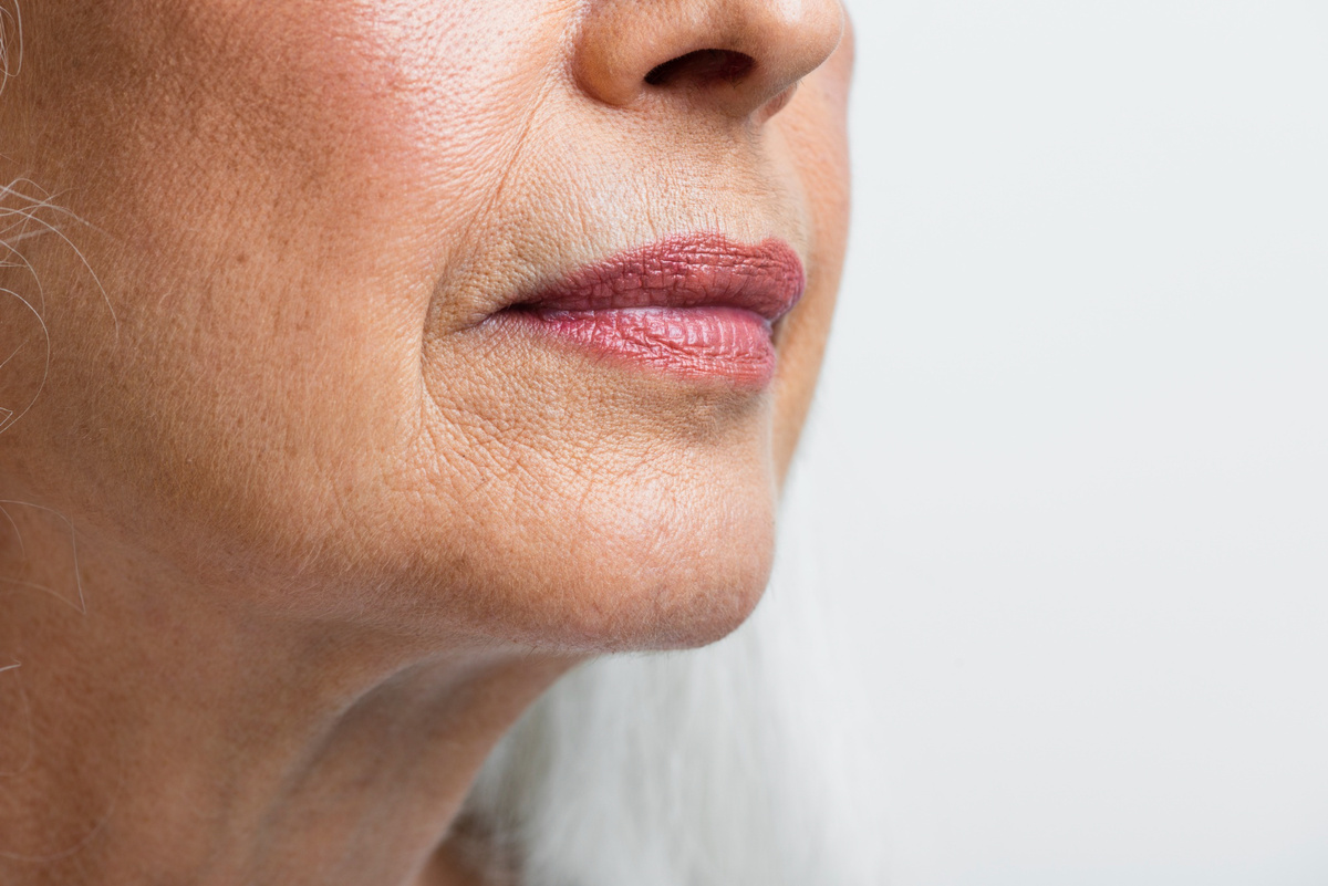 С возрастом из-за снижения коллагена, эластина и гормональных изменений ткани теряют упругость, формируя гравитационный птоз и усиливая опущение уголков губ.