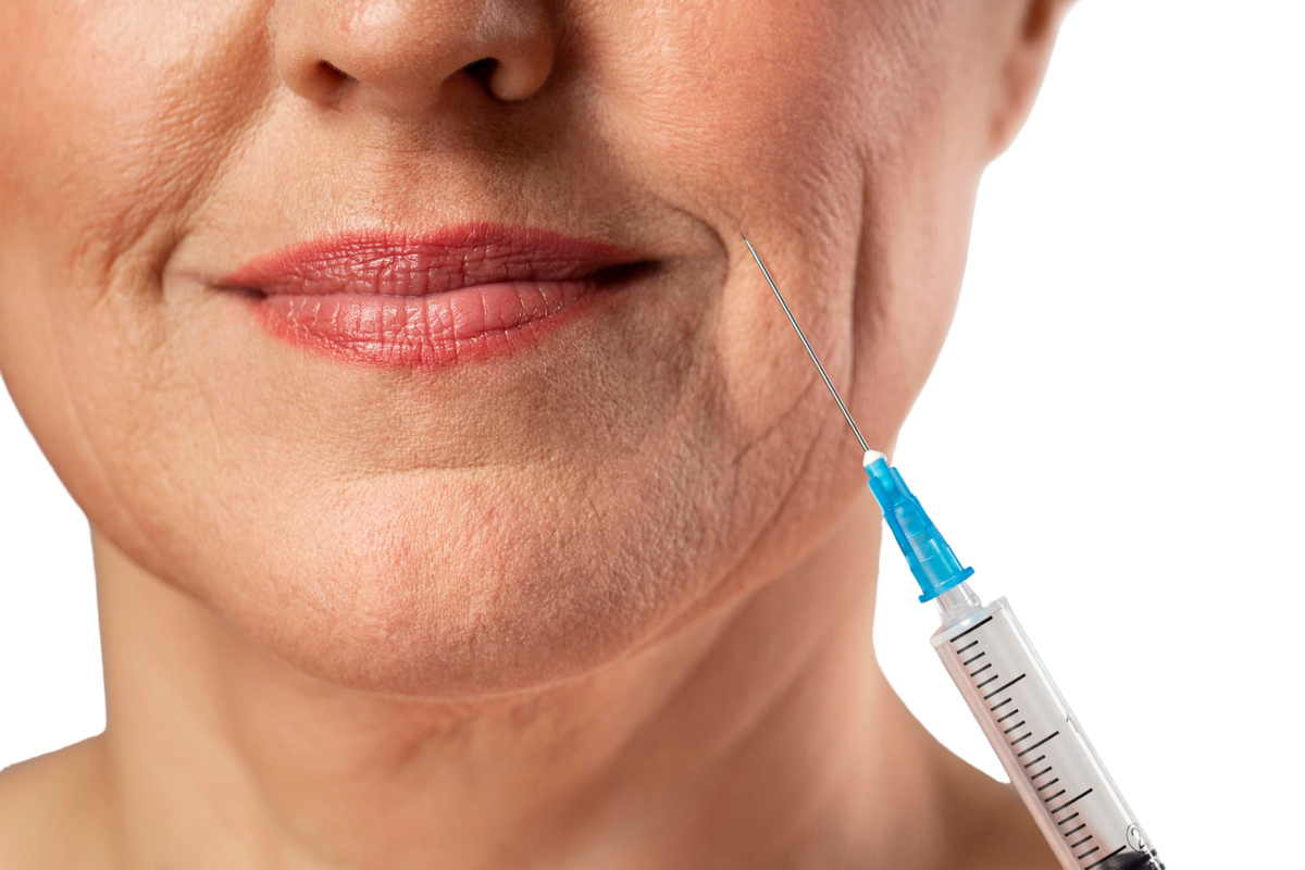 Ботулотоксин мягко корректирует опущенные уголки губ, временно расслабляя мышцы-депрессоры и возвращая лицу нейтральное выражение без изменения формы губ.