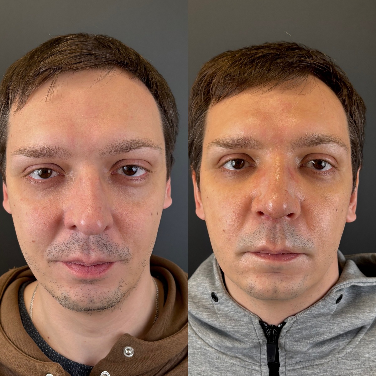 Мужская ринопластика: 10 дней после операции (сразу после снятия лангеты) Слева- до, справа- после. Хирург Остринская Т.В.