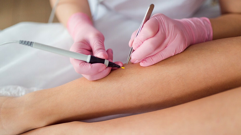 Электроэпиляция — это точечный и максимально радикальный метод удаления волос, который подходит для ограниченных зон и требует осознанного выбора, а не универсального применения.