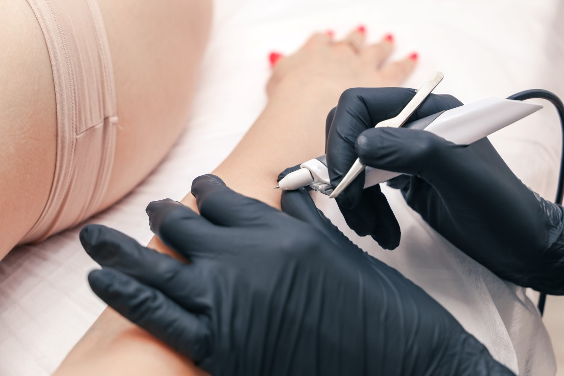 Электроэпиляция — это медленная и более чувствительная процедура с точечной обработкой каждого волоса, после которой возможны временное покраснение и повышенная чувствительность кожи.