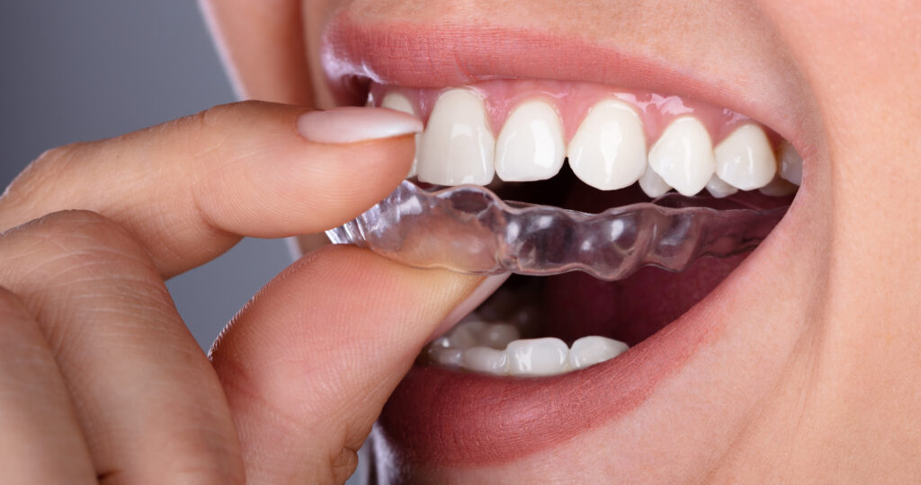 Исправление прикуса – брекеты или элайнеры?