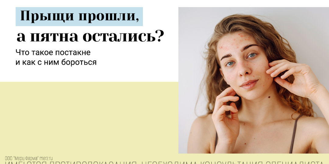 Постакне после праздников: почему высыпания проходят, а пятна остаются