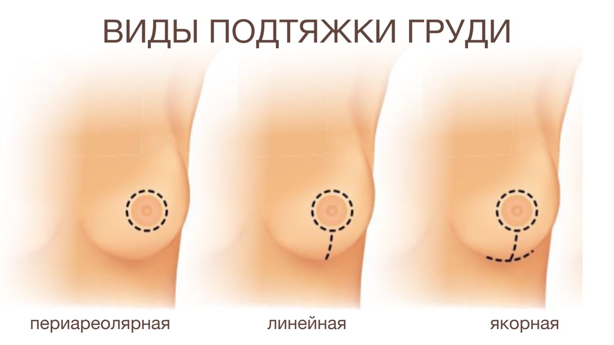 Методы подтяжки груди
