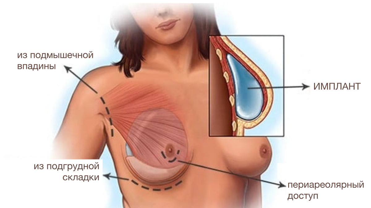 Где находится хирургический доступ