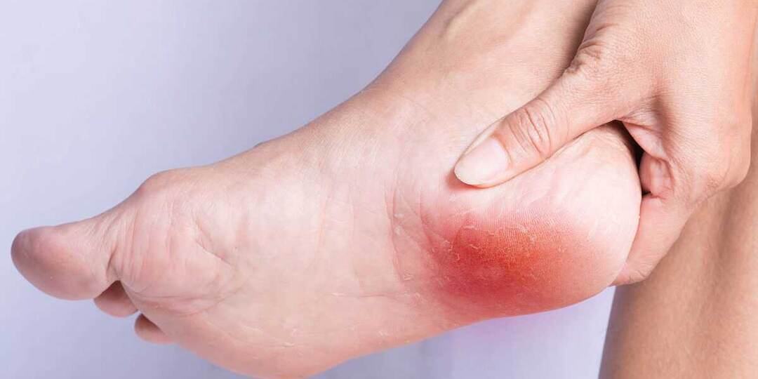 Пяточная шпора: как распознать, вылечить и забыть о боли