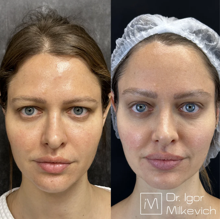 Была выполнена только эндоскопическая подтяжка лба. БЕЗ верхней блефаропластики.